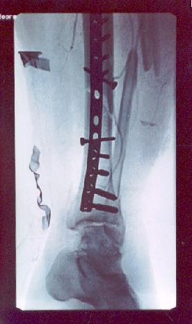 X-ray picture of my shattered leg with a metal strip attached.