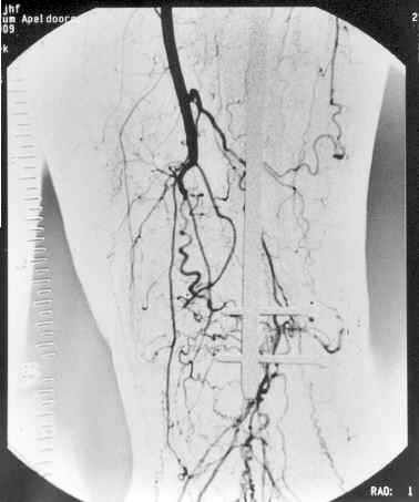 Contrast photo of the bloodvessels in my stump